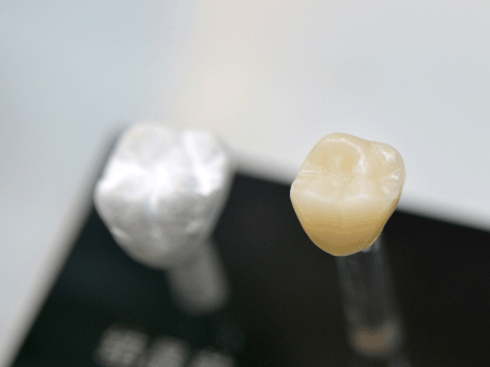 Dental crowns in playa del carmen zirconia and porcelain comparison