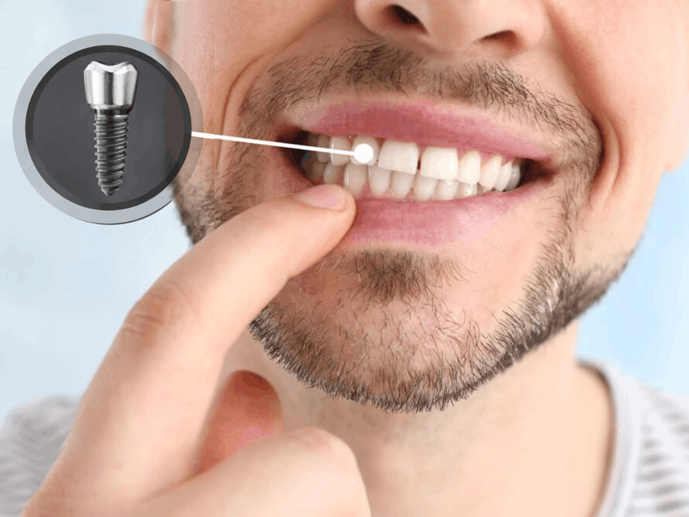 Professional dental implant consultation