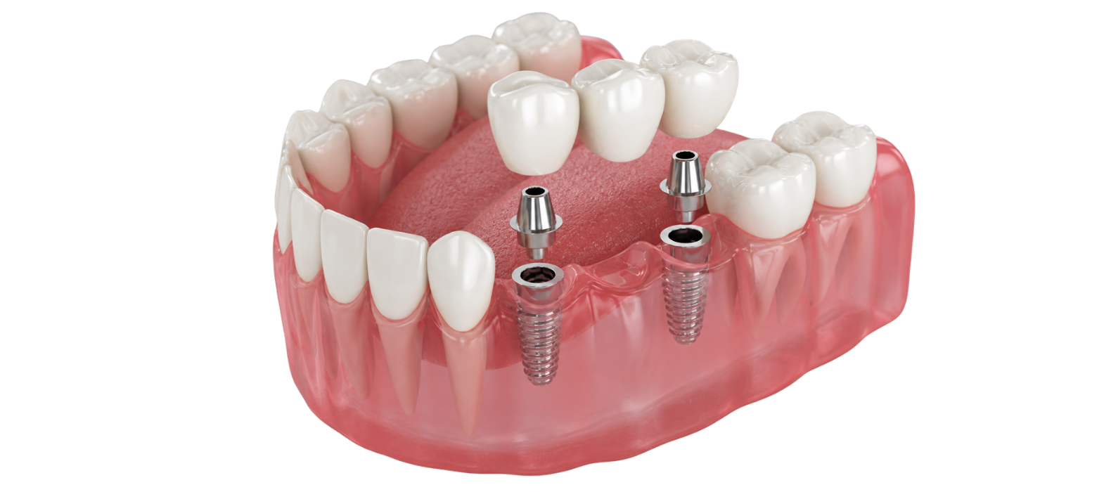 MULTIPLE DENTAL IMPLANTS