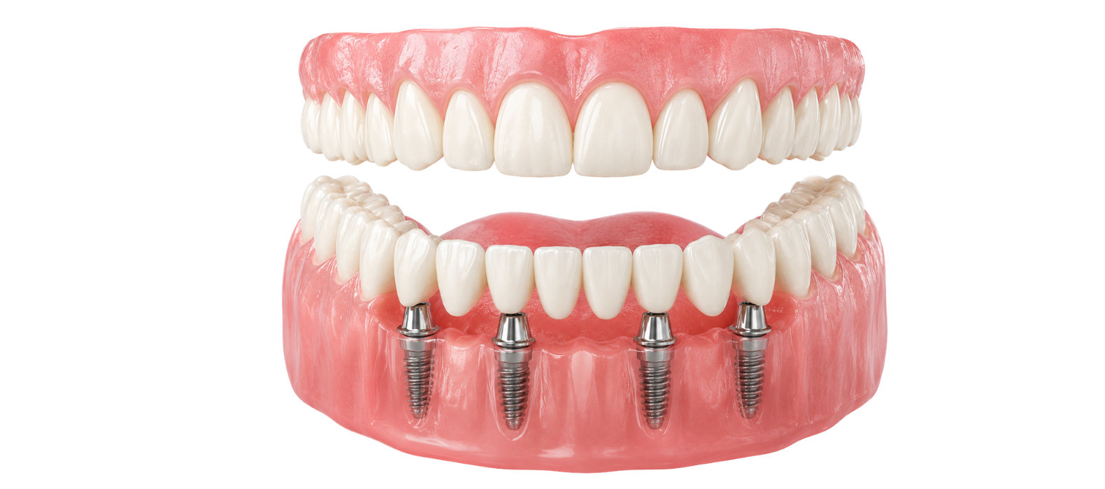 ALL-ON-4 DENTAL IMPLANTS