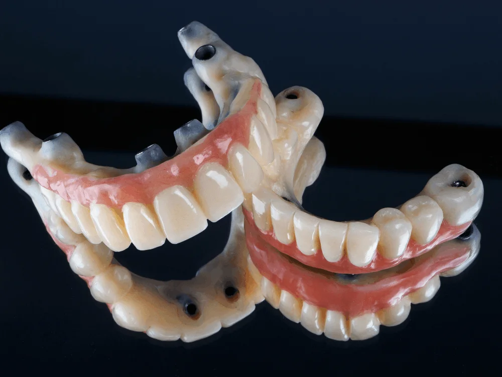 Full-Arch Dental Implants in Mexico