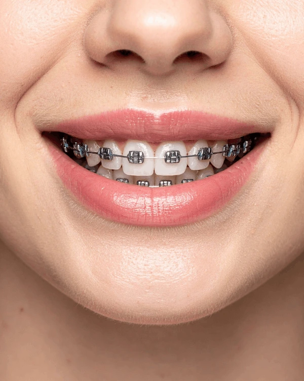 Orthodontist in playa del carmen braces treatment