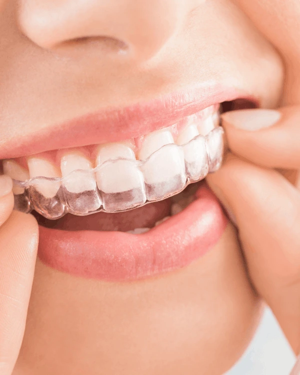 Clear aligners in playa del carmen treatment