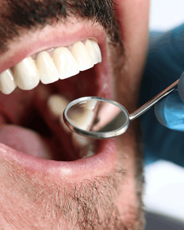 Dental crowns in playa del carmen restoration