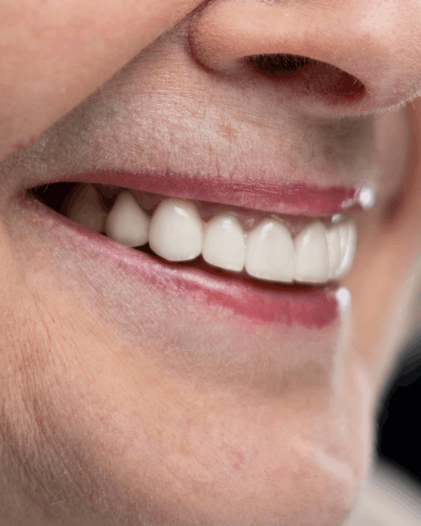 Dental implants in playa del carmen treatment