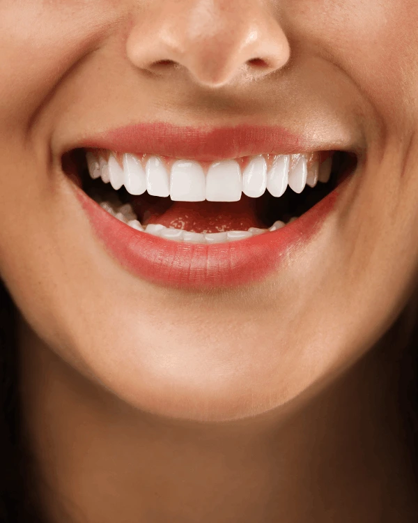 Teeth whitening in playa del carmen results