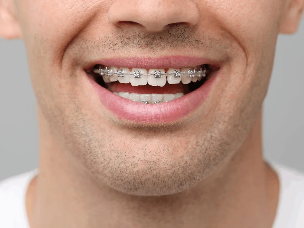 Orthodontist for adults in Mexico