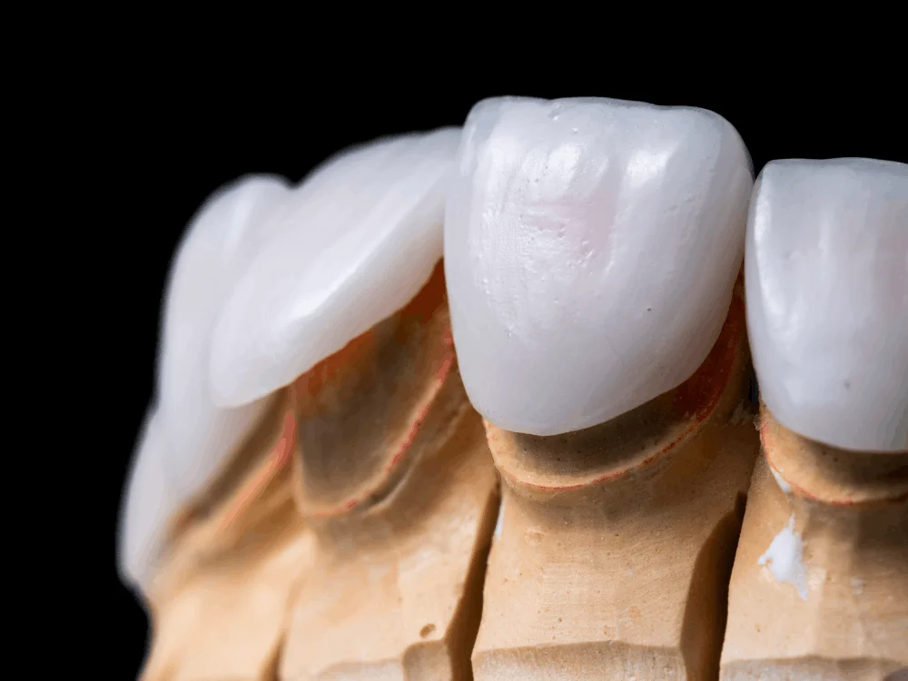 Porcelain veneers smile result Playa del Carmen