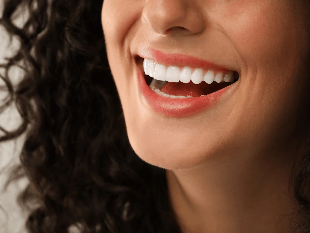 Natural looking porcelain veneers smile Mexico