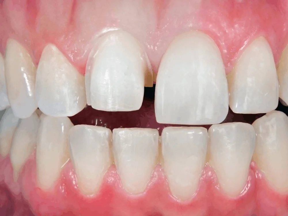 PORCELAIN VENEERS BEFORE AND AFTER RESULTS Before
