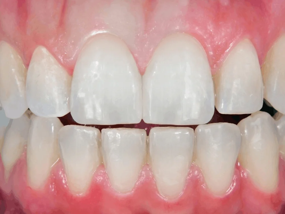 PORCELAIN VENEERS BEFORE AND AFTER RESULTS After